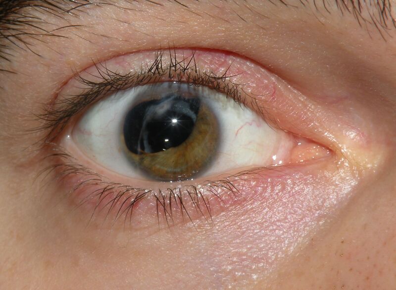 Файл:Iris Lens Injuries with Cataract.JPG