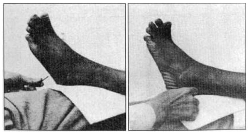 Файл:Chaddock reflex.jpg