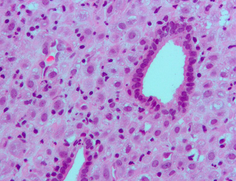 Файл:Endometrium ocp use3.jpg