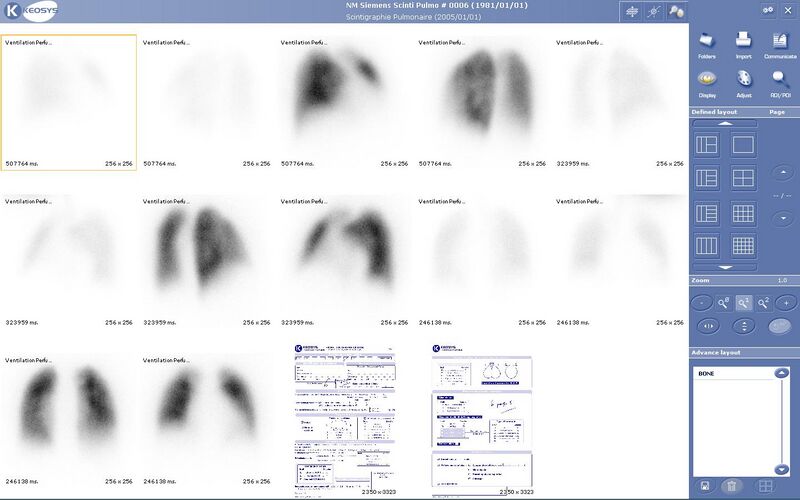 Файл:Lung scintigraphy keosys.JPG