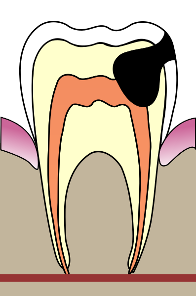 Файл:Cavities evolution 4.svg