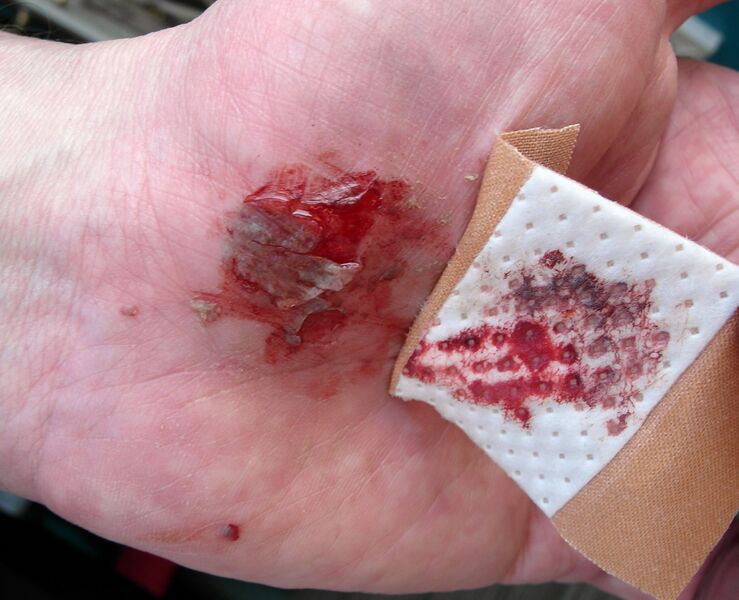 Файл:AfterBicycleFall 0367.JPG