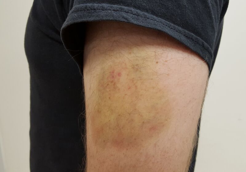 Файл:Upper Arm Bruise.jpg