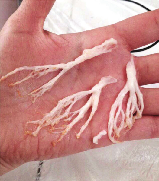 Файл:Plastic bronchitis casts.png