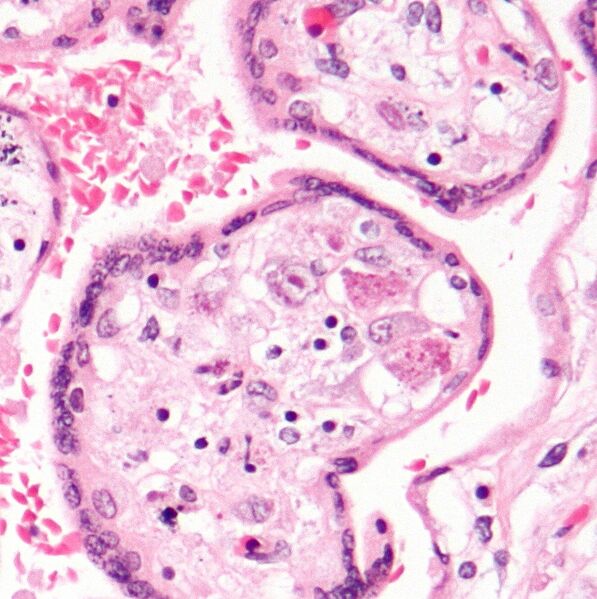 Файл:CMV placentitis2 mini.jpg