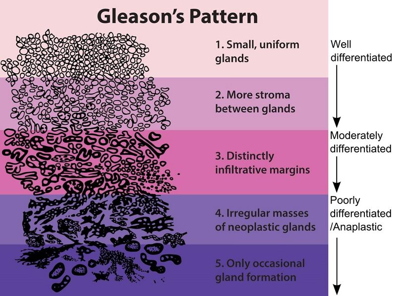 Файл:Gleasonscore.jpg