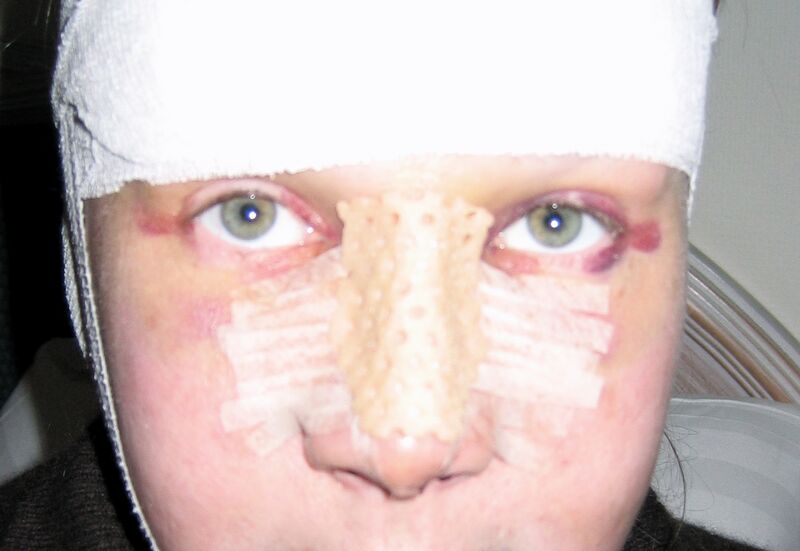 Файл:Rhinoplasty.jpg