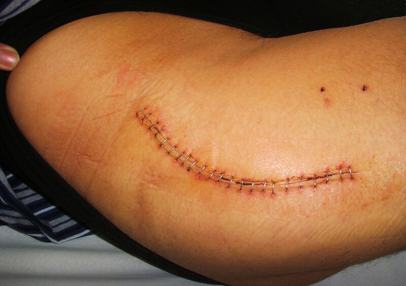 Файл:Hip replacement, surgical staples 01.JPG