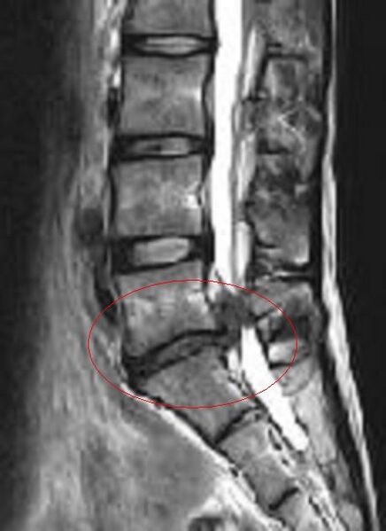 Файл:HerniatedSpinalDisk-NarrowedNerveRoot.JPG