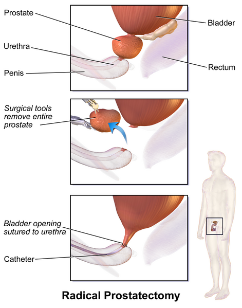 Файл:Prostate Removal.png
