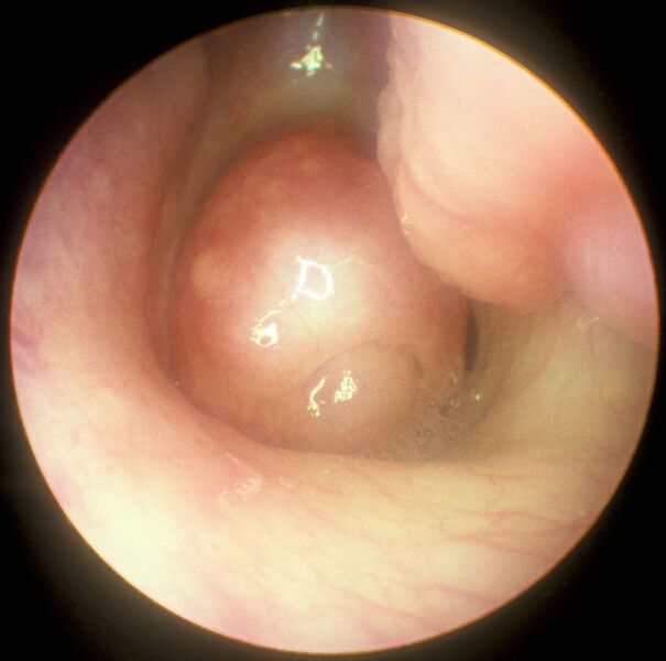 Файл:CHOANAL POLYP PerfectlyClear.jpg