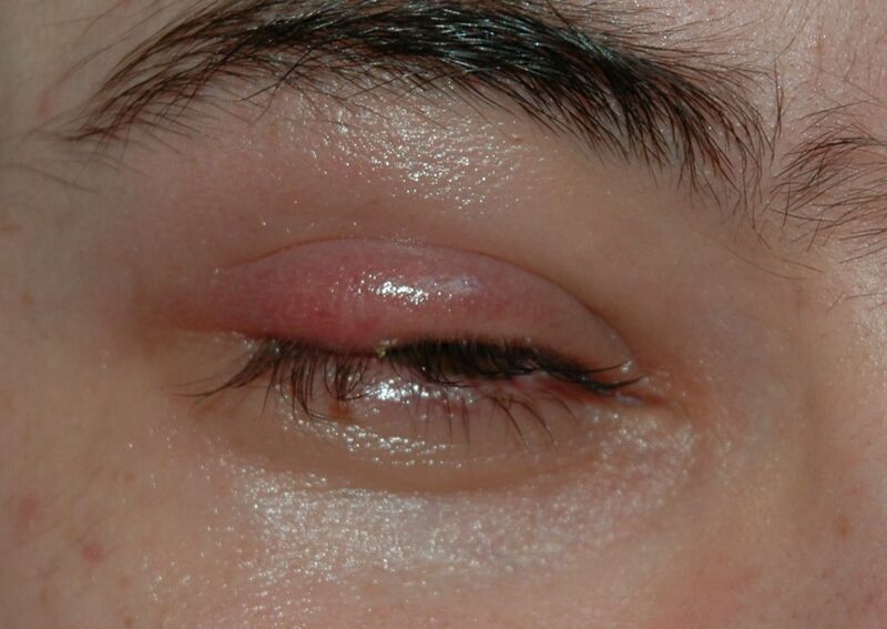 Файл:Stye01.jpg