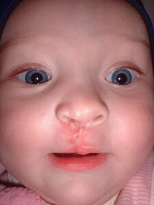Правостороннее расщепление губы и нёба после лечения. Возраст 10 месяцев.