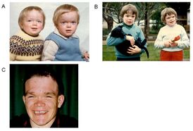 Внешний вид пациентов: A — близнецы в возрасте 18 месяцев: голова увеличена в размерах, короткая шея, округлые брови, седловидный нос и выпуклый лоб; B — те же близнецы в возрасте 8 лет: незначительная атрофия мышц рук; C — мужчина в возрасте 27 лет: слуховой аппарат.