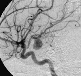 Аневризма артерии головного мозга, визуализируемая посредством ангиографии
