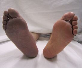 Цианоз нижней правой конечности в результате острого венозного тромбоза правой ноги