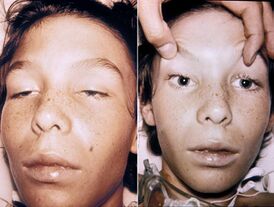 Двусторонняя офтальмоплегия и птоз при ботулизме у 14-летнего ребёнка. Сознание полностью сохранено.
