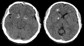 Компьютерная томограмма головного мозга пациента с синдромом Ди Георга демонстрирует кальцификацию базальных ганглиев и перивентрикулярное обызвествление. (По материалам Tonelli et al., 2007).
