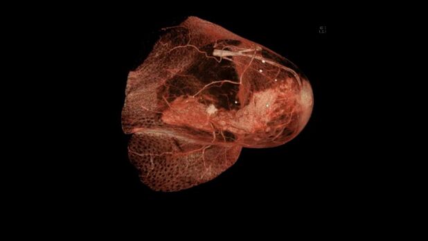 Раковая опухоль на снимке компьютерной томографии груди