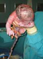 Новорождённый после кесарева сечения. Пуповина не перерезана