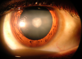 Увеличенный вид катаракты в человеческом глазу при освещении диффузным светом щелевой лампы