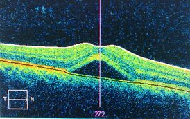 Возникновение центральной серозной ретинопатии в центральной ямке показанное с помощью оптической когерентной томографии.