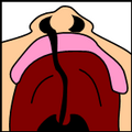 Cleftpalate1.png