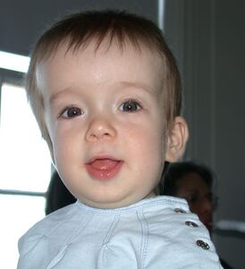 Ребенок с краниосиностозом.