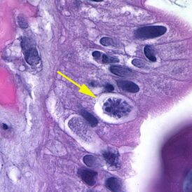 Ооциста Cystoisospora belli в клетке эпителия