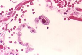 Цитомегаловирусная инфекция клетки лёгкого (клетка с увеличенным ядром, в центре)
