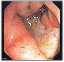 Изображение язвы желудка, полученное с помощью эндоскопа
