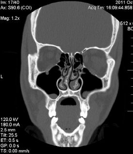 Изображение компьютерной томографии, показывающее врожденное отклонение носовой перегородки