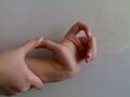 Гипермобильный пястно-фаланговый сустав I пальца