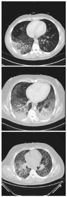 Изображения компьютерной томографии, показывающие диффузные инфильтраты в лёгких у трех пациентов, 2019 год