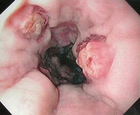 Эндоскопический снимок язв пищевода после лигирования варикозно расширенных вен пищевода во время ВЭГДС.