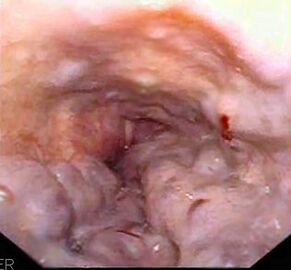 Эндоскопия пищевода пациента с варикозным расширением вен пищевода