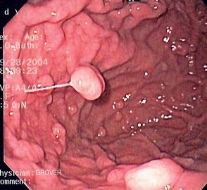Полипы фундальных желёз желудка. Изображение получено с помощью фиброгастроскопа
