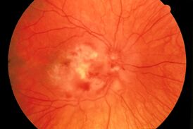 Фотография глазного дна с CMV ретинитом
