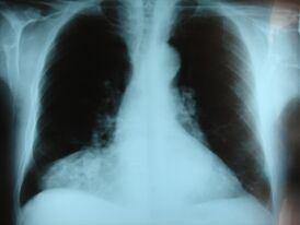 Фронтальный рентгеновский снимок грыжи Морганьи.