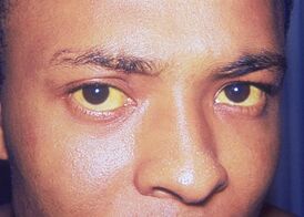Пожелтение кожи и белков глаз (иктеричность), вызванное гепатитом А.