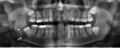 На панорамной рентгенограмме зубов видна зубная киста (отмечена стрелкой).