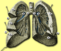 Анатомия лёгких
