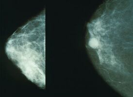 Mammo breast cancer.jpg