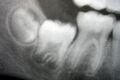 Рентгенограмма (слева-направо) третьего, второго и первого коренных зубов в различных стадиях развития