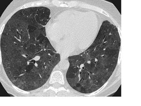 КТ-картина экзогенного аллергического альвеолита с облитетирующим бронхиолитом («воздушные ловушки»).