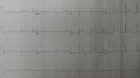 ЭКГ признаки перикардита. Подъём сегмента ST на кардиограмме.