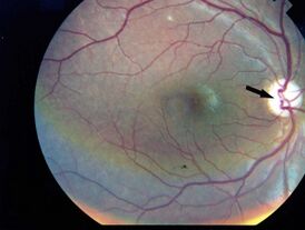 Фотография глазного дна правого глаза пациента — наличие атрофии диска зрительного нерва без признаков диабетической ретинопатии (Manaviat и соавт., 2009[1])