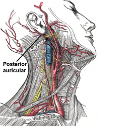 Поверхностное рассечение правой половины шеи. Показаны сонные и подключичная артерии.