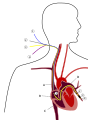 Схема катетеризации правых отделов сердца и лёгочной артерии через наружную ярёмную вену