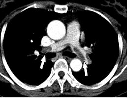 КТ-картина тромбоэмболии главных лёгочных артерий при КТ-ангиопульмонографии.